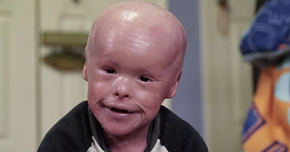 Baby Is Born With Extremely Rare Skin Condition. His Attitude About It Blows Me Away!