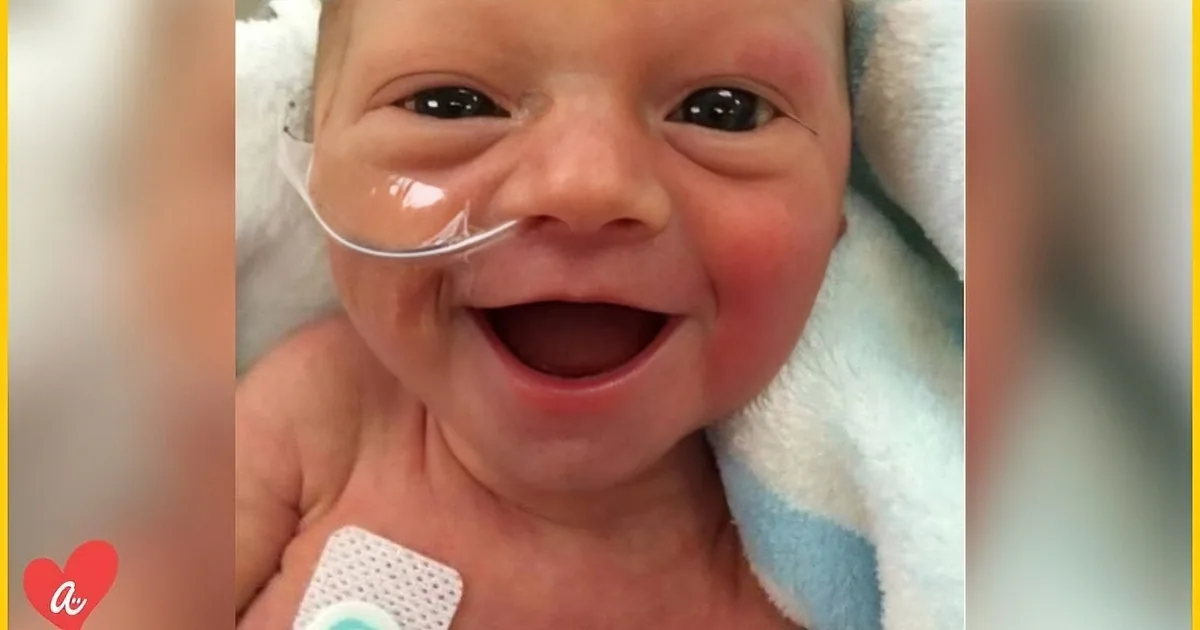 A newborn baby smiles widely, wearing a nasal cannula and a bandage on its chest.
