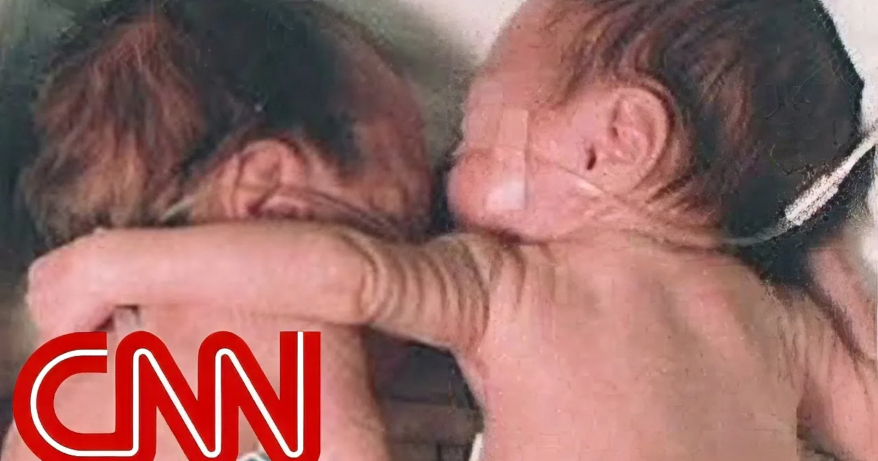 One Twin Was Just About to Pass Away, You Will Want to See What Saved Her!