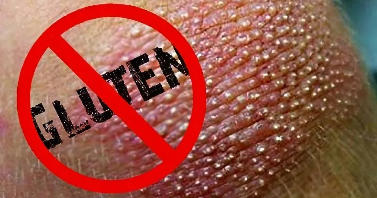A close-up of skin with a red "no" symbol and "gluten" crossed out.
