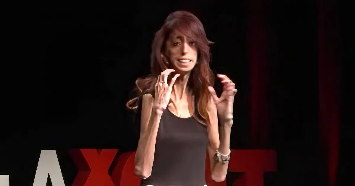 Bullied for Looking Different, Her Inner Strength Has Silenced the Haters