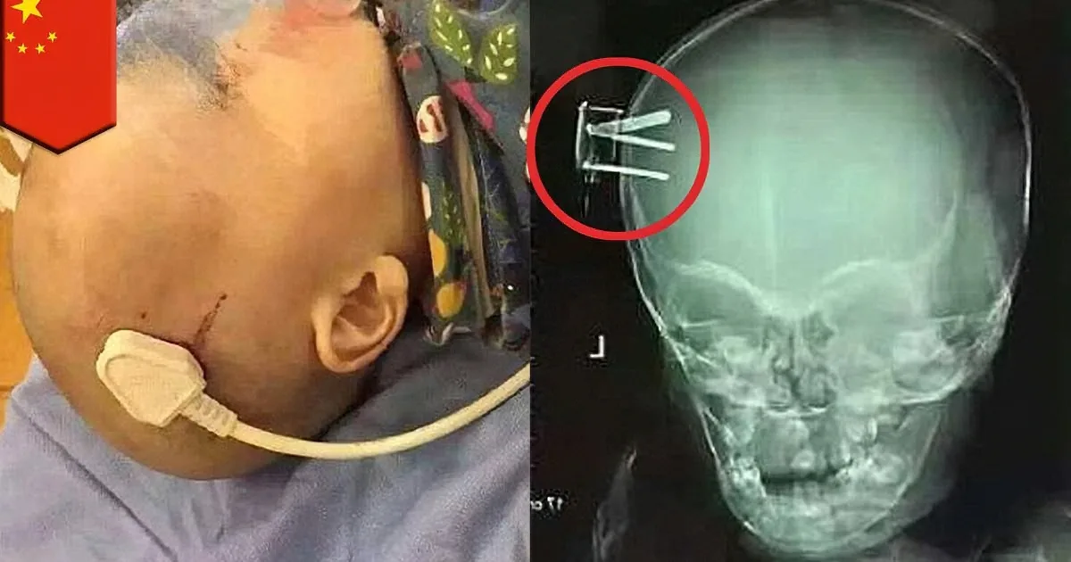 A child with a shaved head and a medical device, alongside an X-ray showing metal rods in the skull.