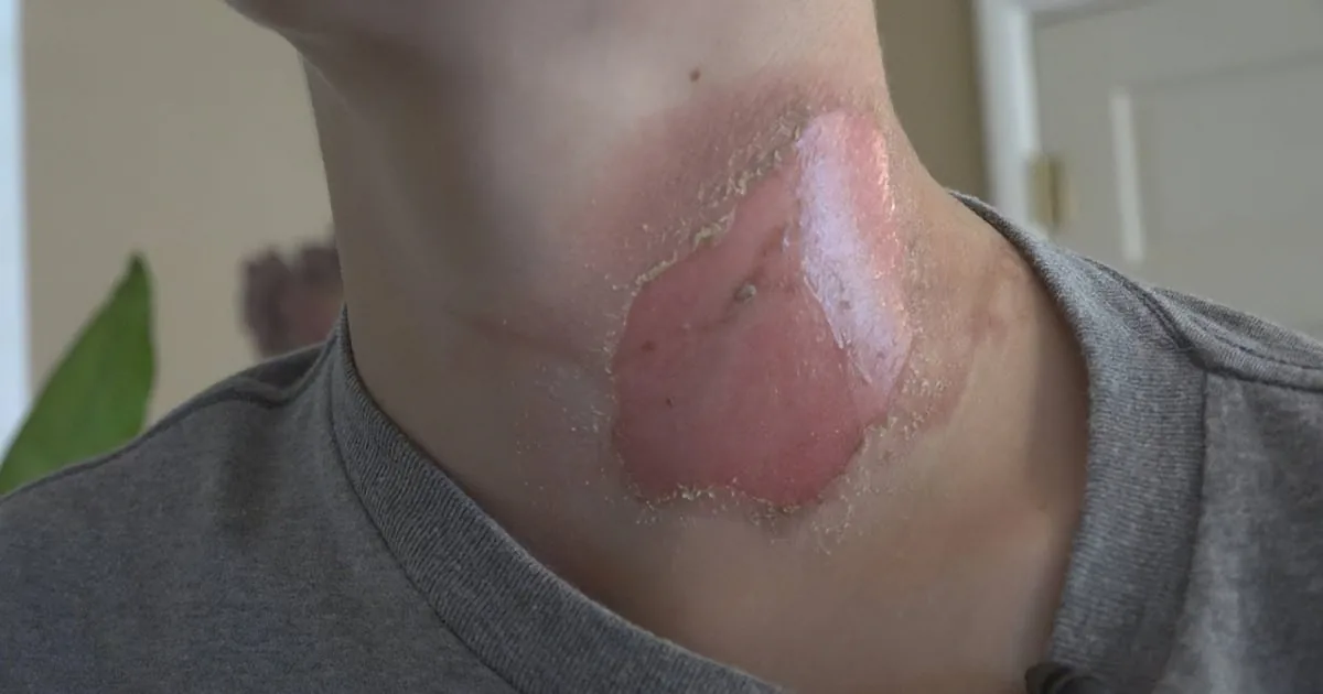Kids Suffer Disfigurement and Death Thanks to a New Internet ''Challenge''