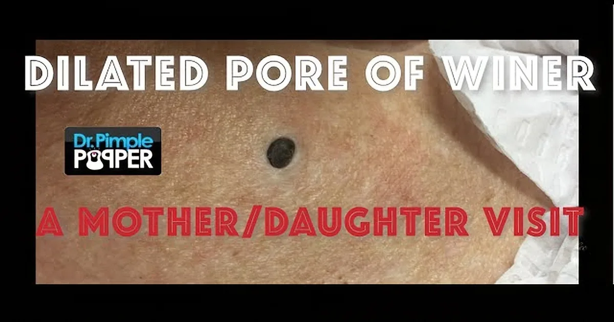85-Year-Old Grandma Has 'Mole' on Her Back - You Won't Believe What It Really Is