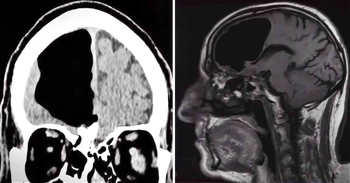MRI showing brain structure with possible abnormality in the left hemisphere.