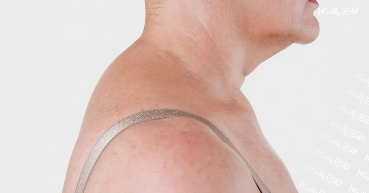 A person's shoulder with a metallic band around it, showing a sunburn.