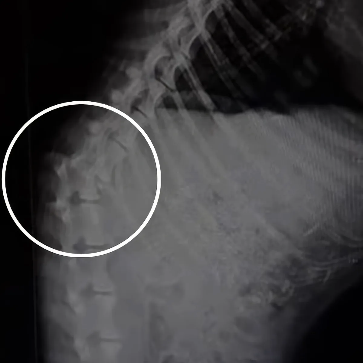 A radiograph highlighting a vertebral body with a white circle, likely indicating a medical concern.