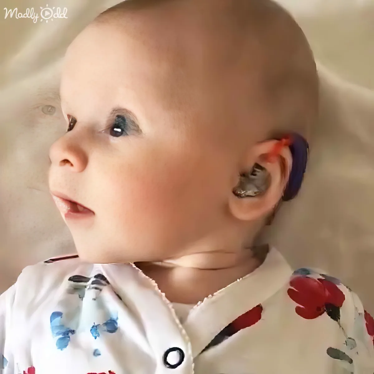 A baby wearing a floral onesie looks to the side with a hearing aid in one ear.